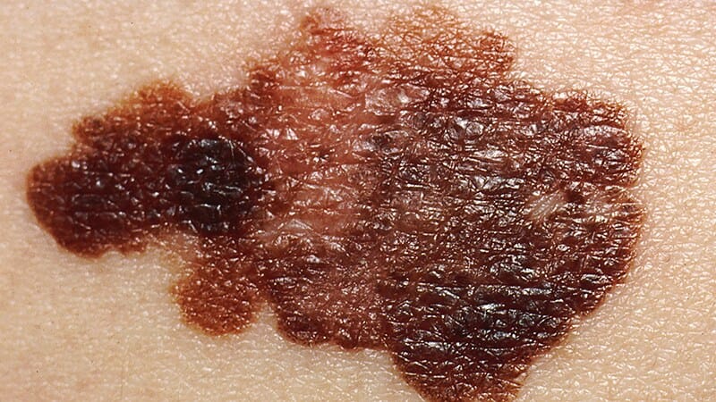 Fast Five Quiz: Melanoma