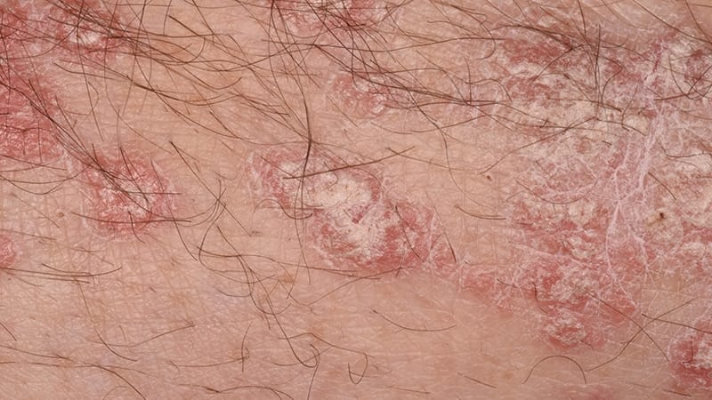 Fast Five Quiz: Plaque Psoriasis Management
