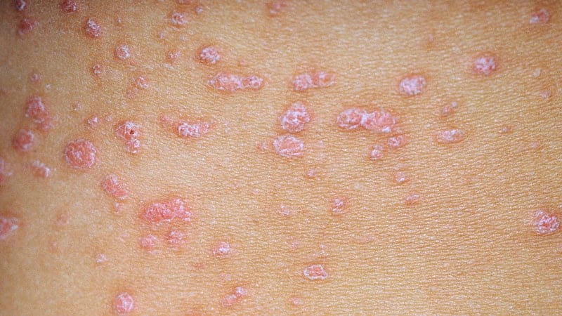 Fast Five Quiz: Psoriasis Types