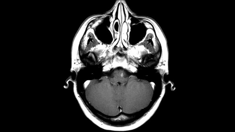 Fast Five Quiz: Treatment in Relapsed MS