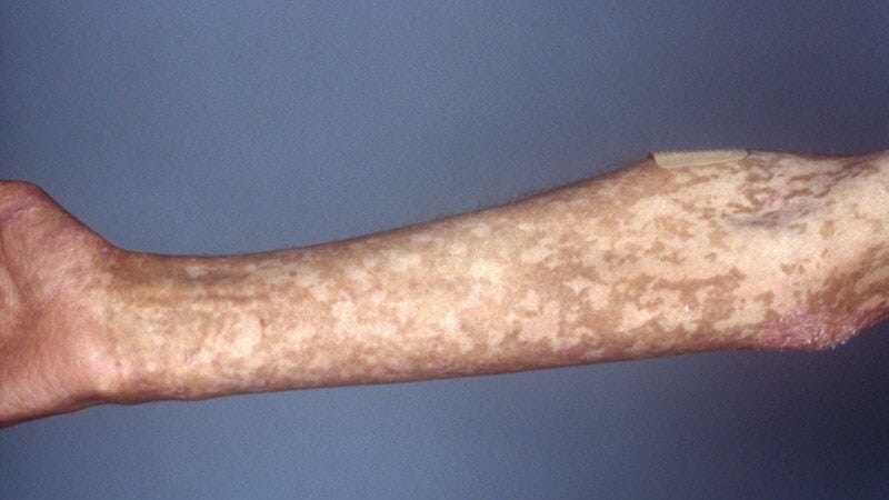 Fast Five Quiz: Presentation and Diagnosis of Chronic GVHD