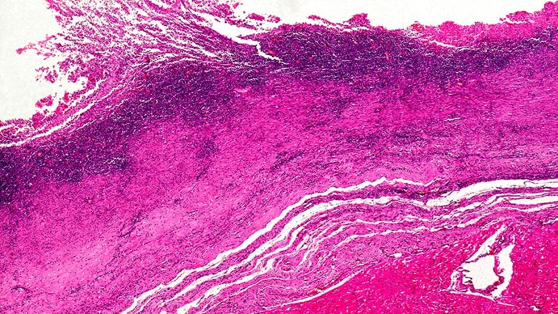 Fast Five Quiz: Transthyretin Amyloid Cardiomyopathy Management