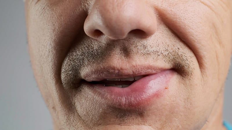 Lipid-Lowering Drugs Tied to Worse Venom Anaphylaxis