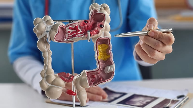 Acute Severe Ulcerative Colitis: 10 Risks in Older Adults