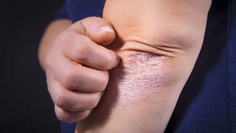 E-cigarette et psoriasis, pas de fumée sans feu ?