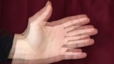 photo of A person's hand with tremors due to Parkinson's disease. A trembling hand showing tremors due to a condition such as