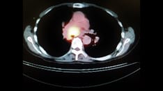 photo of PET/CT mediastinal tumor invading the lung