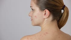 photo of Beautiful young girl with acne on her face and back against a white background. Beautiful young girl with acne on he