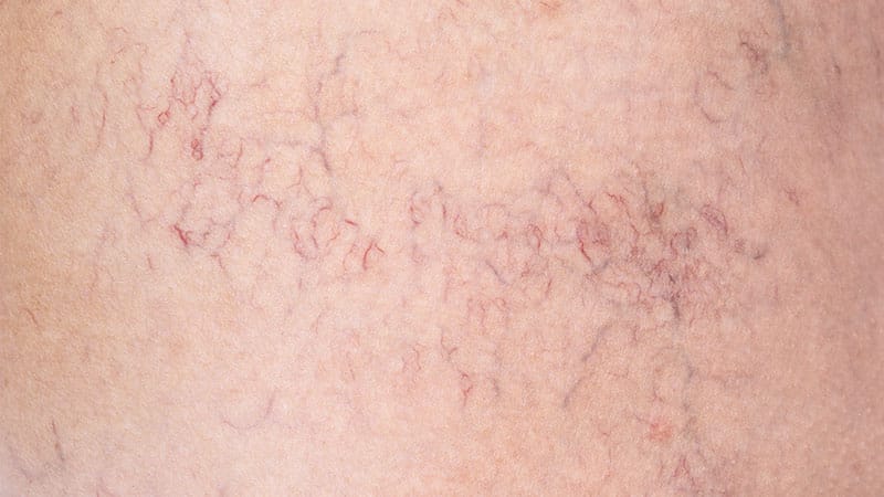 Des indices sur la peau pour le diagnostic de la maladie de Fabry