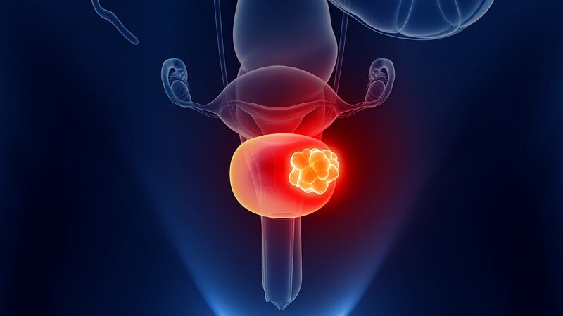 UK Guidelines Offer Coherent Approach to Rare Bladder Cancer