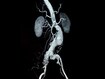 dt_191028_AAA_abdominal_aortic_aneurysm_800x450.jpg