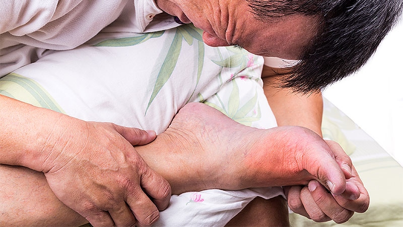 Gout: Suboptimal Management a Continuing Problem