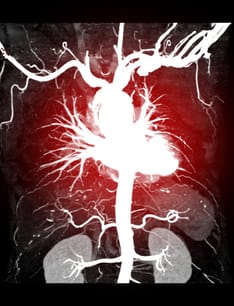 photo of thoracic aorta 