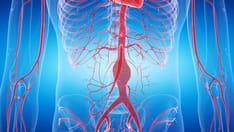 photo of aneurysm