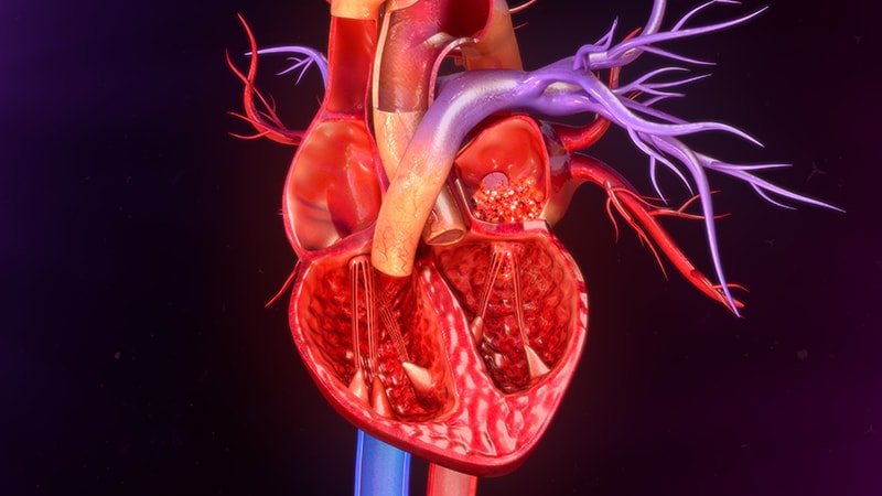 Myocardite fulminante : intérêt de la biopsie myocardique précoce