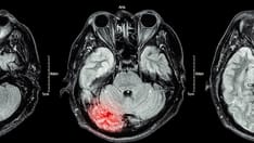 photo of brain MRI