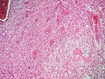 photo of glioma