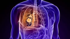 photo of lung cancer