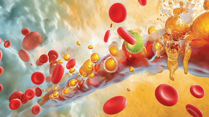 Nouveau consensus français sur les dyslipidémies de l'adulte