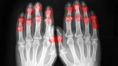 photo of arthritis