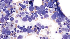 photo of lymphoma