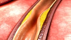 photo of coronary artery