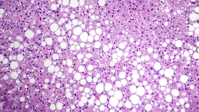 Recommandations HAS - Comment traiter les condylomes?