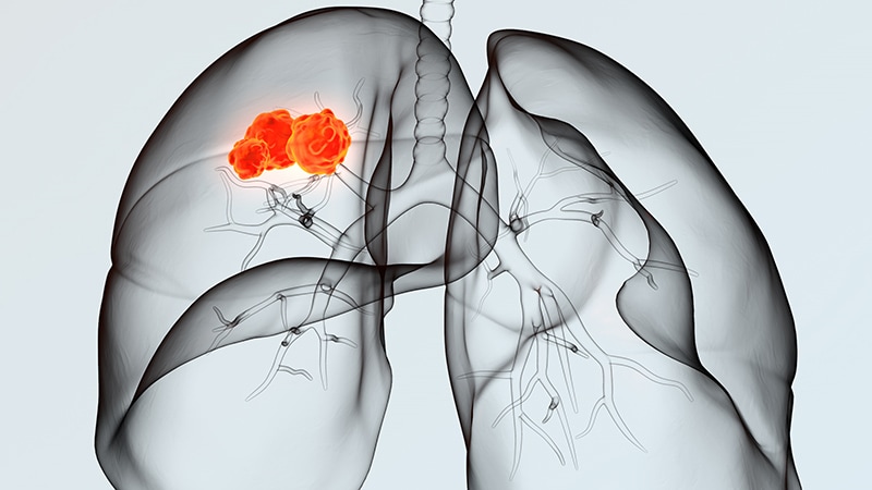 Air Pollution in England, 3 Countries Tied to Lung Cancer