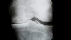 photo of knee joint