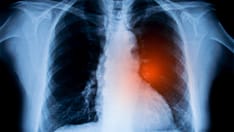 photo of lungs xray
