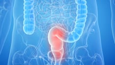 photo of inflamed rectum