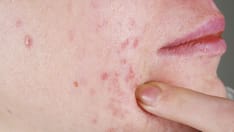 photo of acne