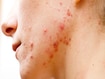 photo of acne skin