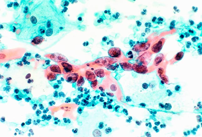 Diagnosis and Treatment of Cervical Cancer