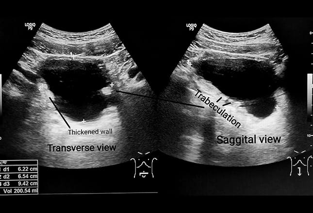 Diagnosis and Treatment of Cervical Cancer