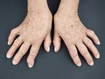 Rheumatoid arthritis