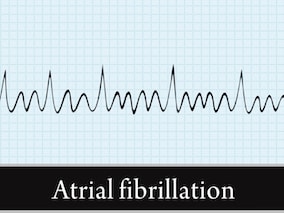 Nice: Updated Guidance On Atrial Fibrillation