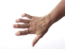 Rheumatoid arthritis.jpg