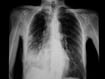 CoV pneumonia Xray.jpg