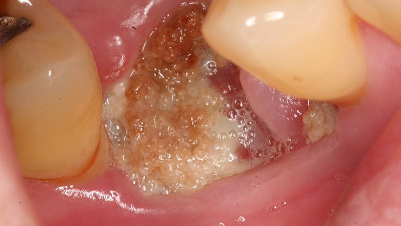 Antiresorptive Jaw Osteonecrosis Risks Compared in New Study