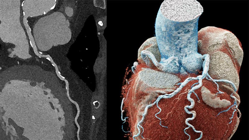 Is Photon-Counting CT the Next Big Thing in Cardiac Imaging?