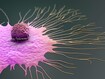 photo of breast cancer