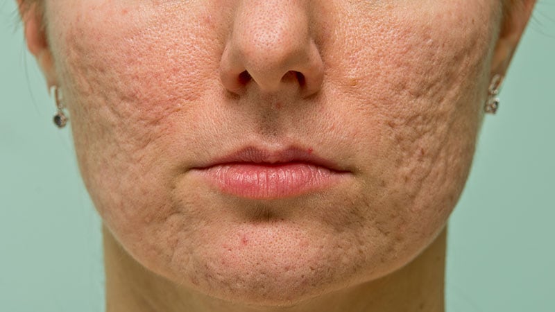 La stigmatisation liée à l’acné persiste dans les milieux sociaux et professionnels