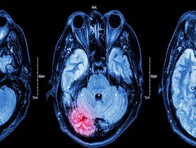 photo of MRI of brain : brain injury