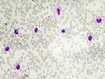 photo of  Leuco- erythroblastic anemia.
