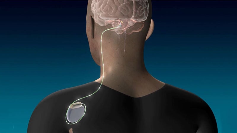 Deep Brain Stimulation Promising in Post-Stroke Recovery