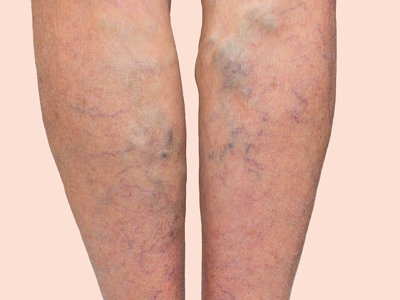 NICE Innovative Procedure to Treat Varicose Veins