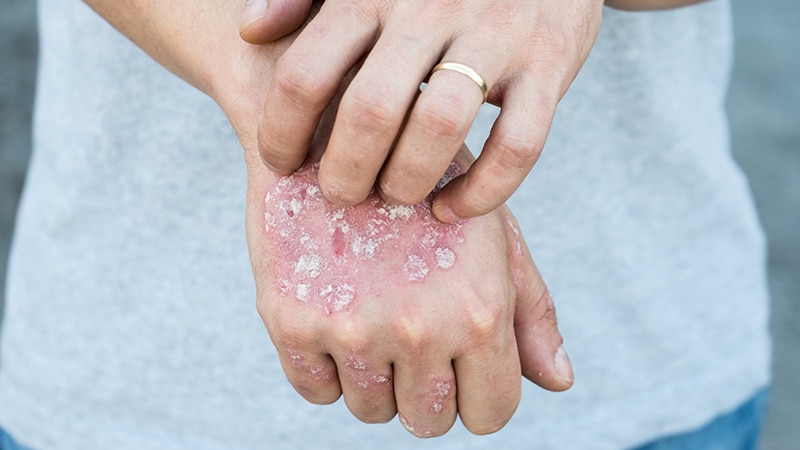 Anti-IL-17, Anti-IL-23 Rxs Present Sustained Psoriasis Management