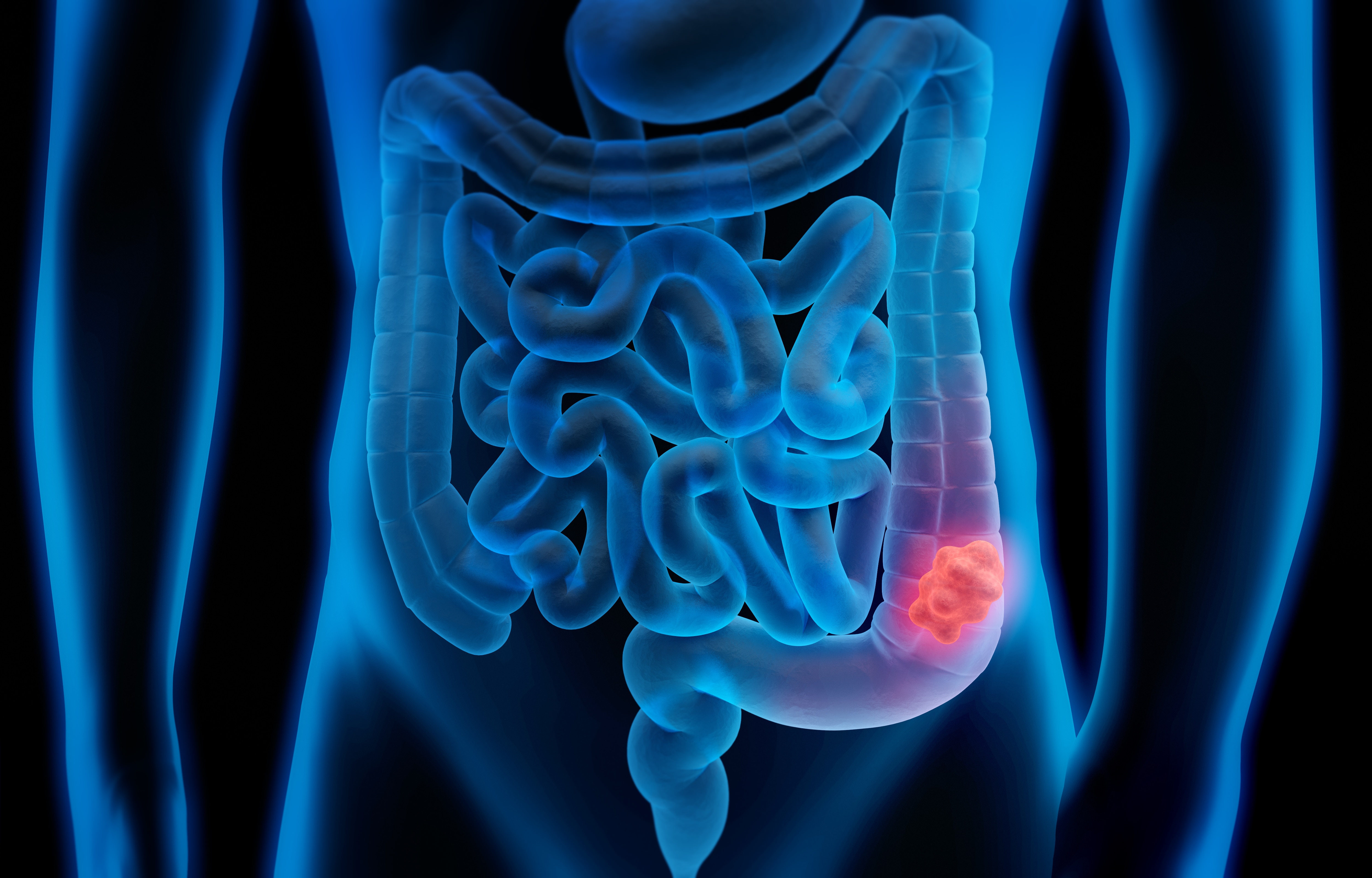 Bowel screening programme resumes in Scotland