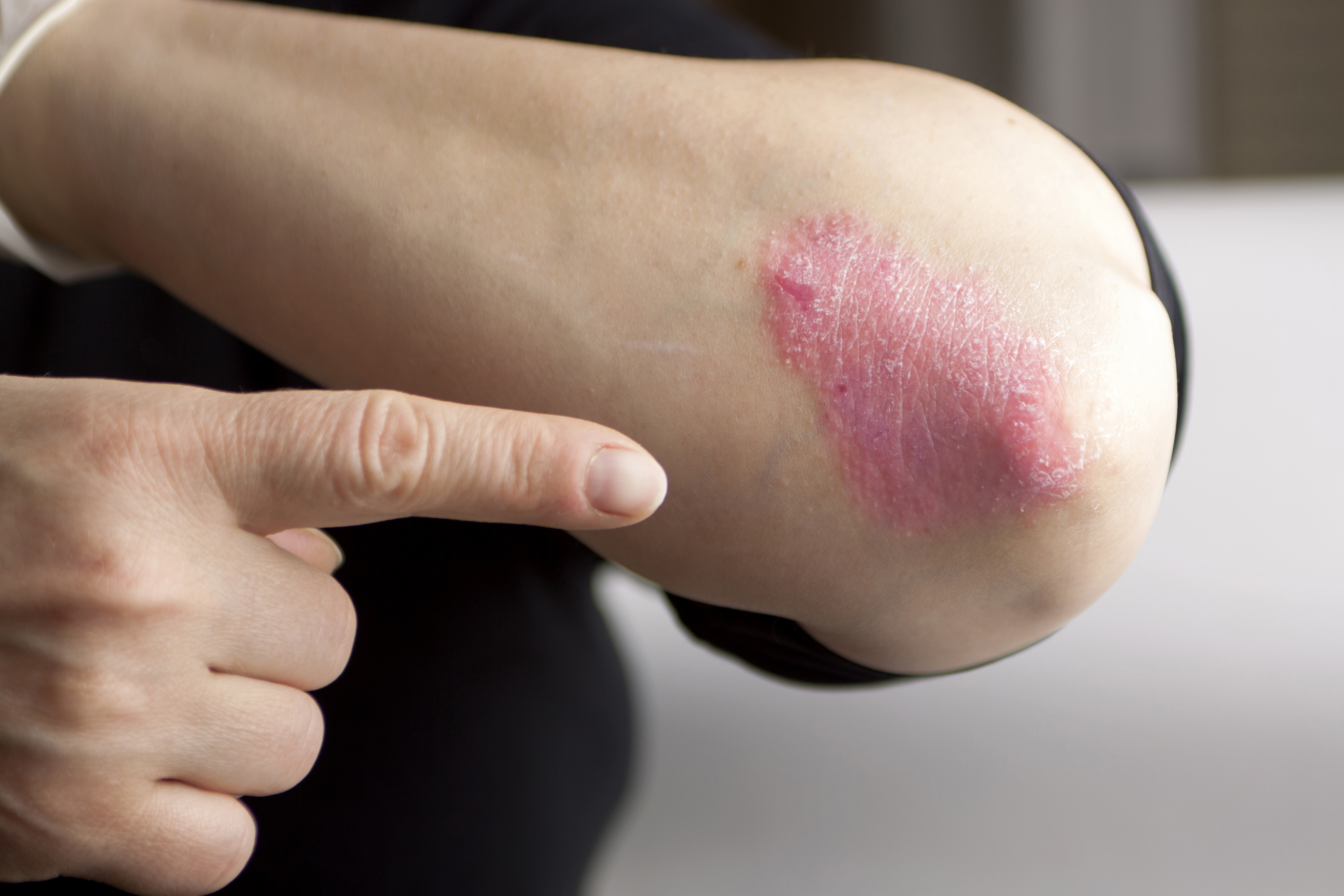 Nice Recommends New Biological Therapy For Treating Plaque Psoriasis 